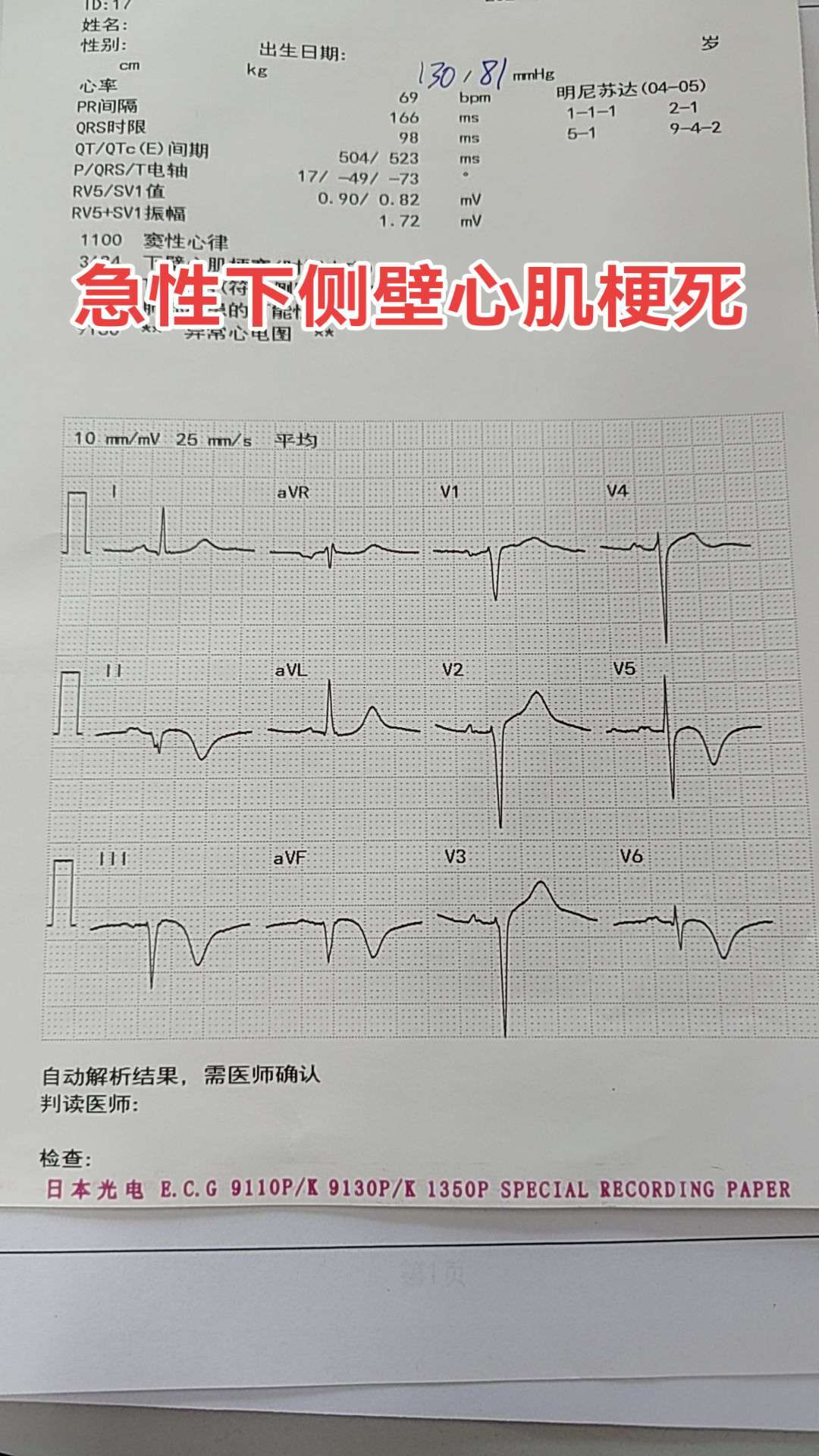 急性心梗。急性下侧壁心肌梗死，造影提示右冠脉完全闭塞，发病时间短，但右...