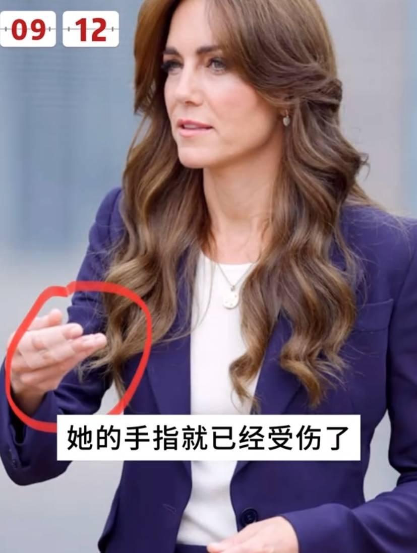 #凯特王妃# 凯特就诊的高级医院出丑闻，有人试图查阅王妃的医疗记录，已被捕！据了