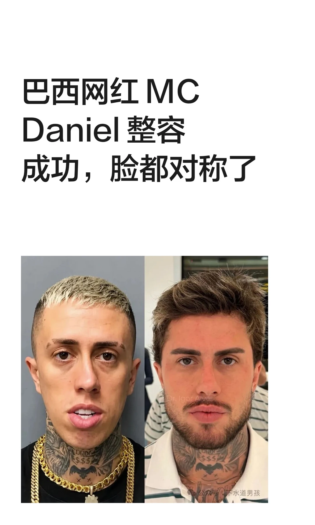 巴西网红 MC Daniel 整容成功，脸都对称了