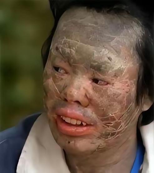 吃蛇太多变蛇人？辽宁村民韩永波爱吃蛇，吃了多年没出事，直到一条黄花松蛇下肚，皮肤