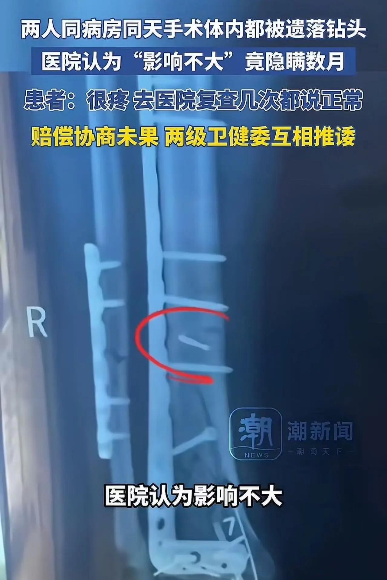 体内遗落钻头仅罚3万？3分钱的处罚背后，是人命价值的危险标价

“离了个大谱！”