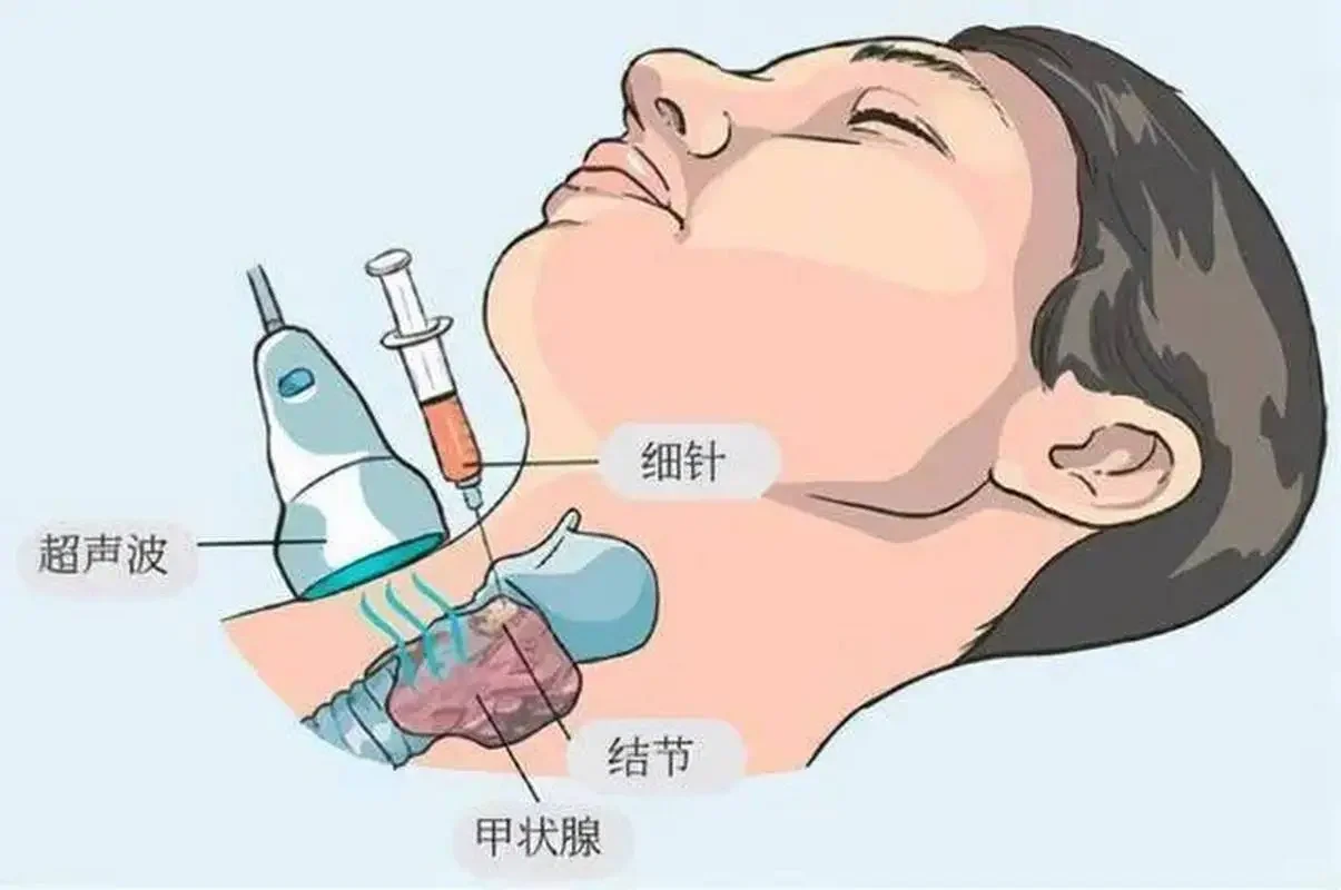 【甲状腺细针穿刺后】注意事项