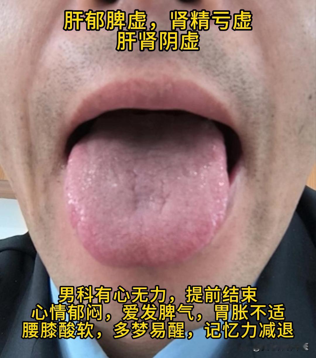 今天有时间，可以帮大家看看舌象。

有需要的，尽管把你的舌象照片发过来吧！越早发
