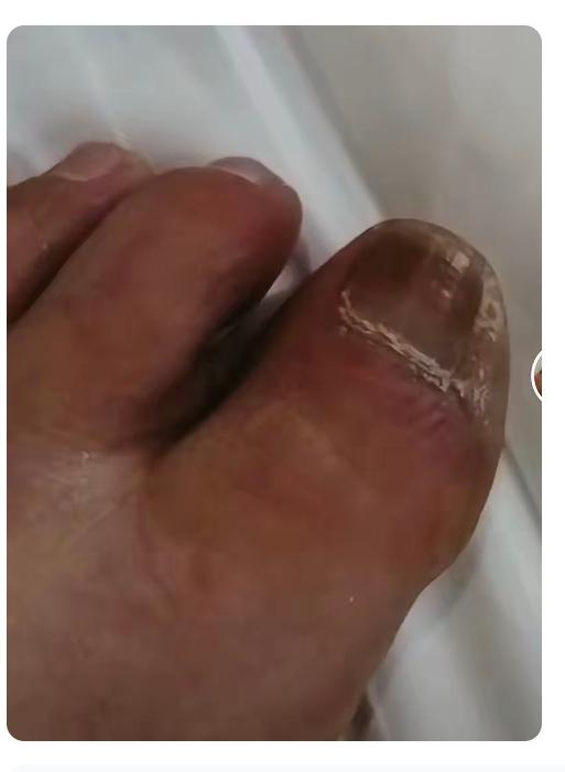 糖尿病到这种程度，是不是快截肢了？先切去一个脚趾头，慢慢是脚，然后是腿，这程序是