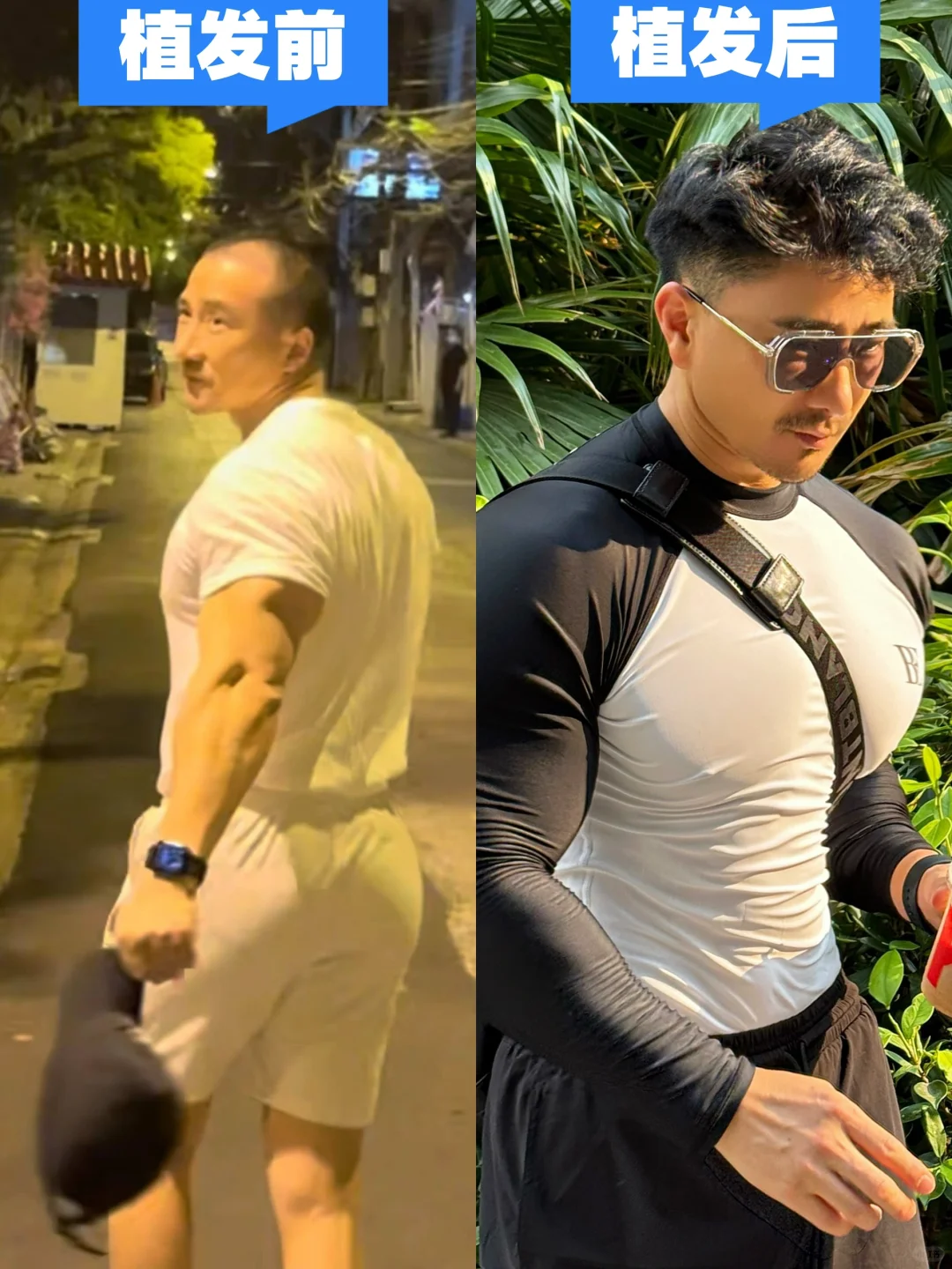 来看看我的植发效果怎么样啊，一年了⚫️