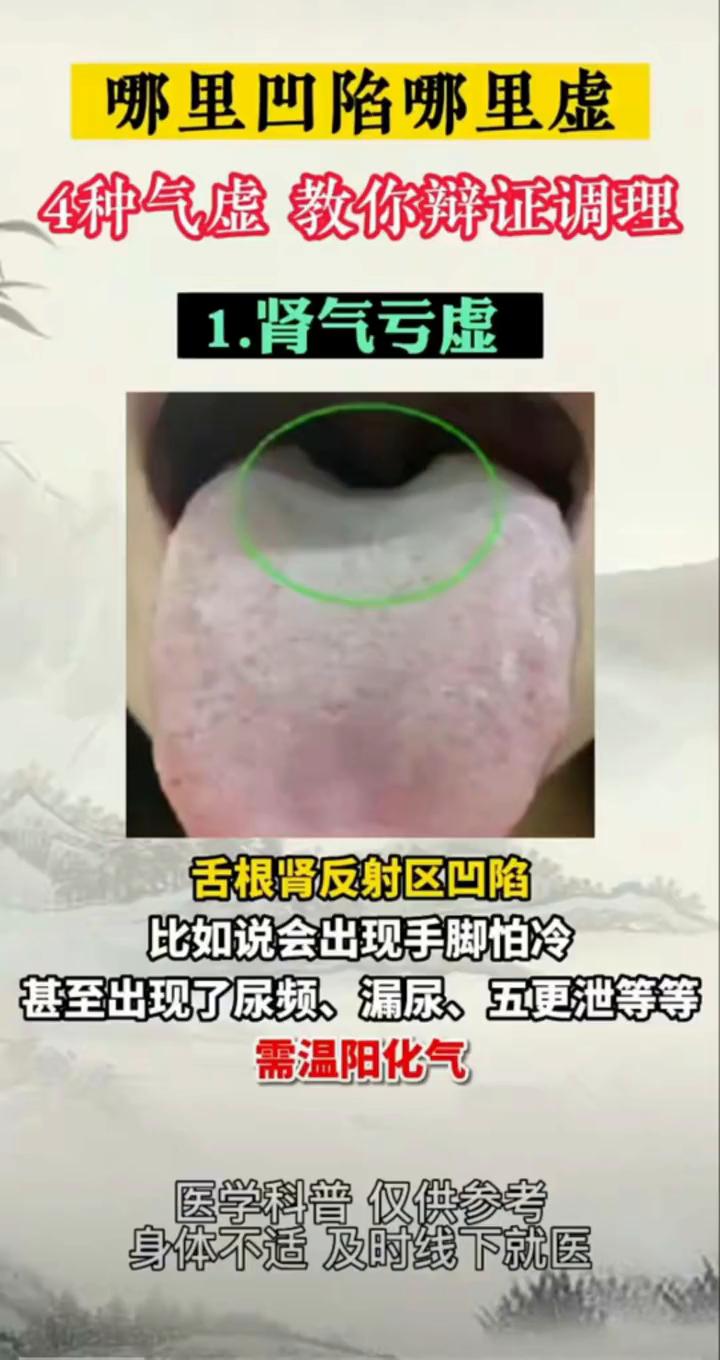 哪里凹陷哪里虚，4种气虚教你辩证调理。
·1.肾气亏虚：舌根肾反射区凹陷，比如说