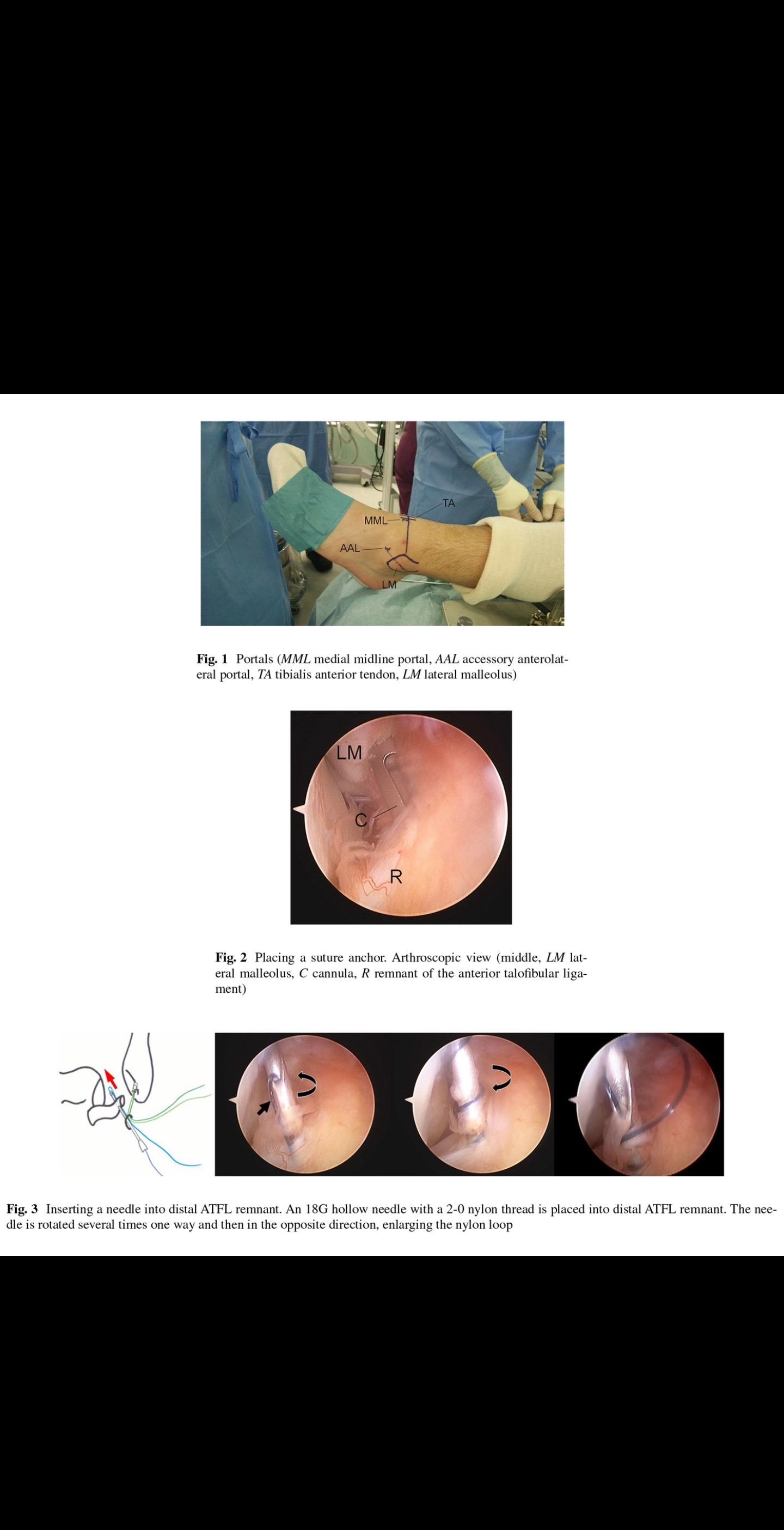 关节镜下距腓前韧带修复。Masato Takao方法，经典！！！