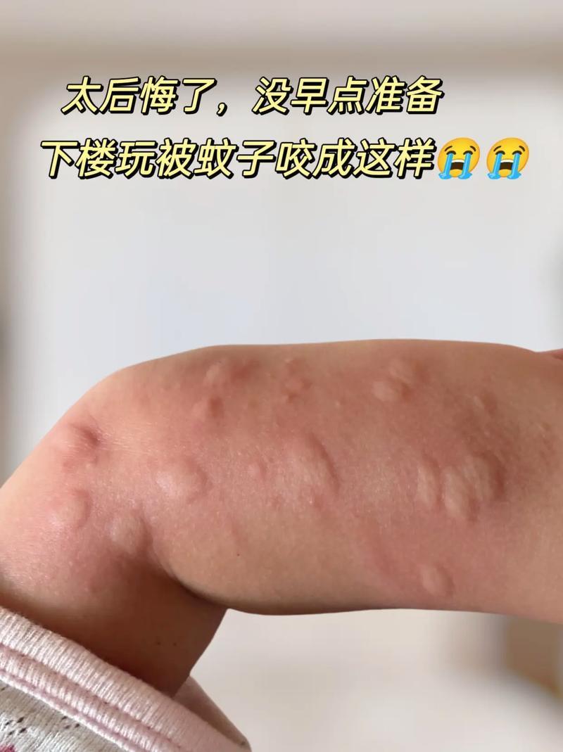 被蚊子叮咬后为啥会起肿包？
       实则是免疫系统在运作，蚊子叮人时，通过