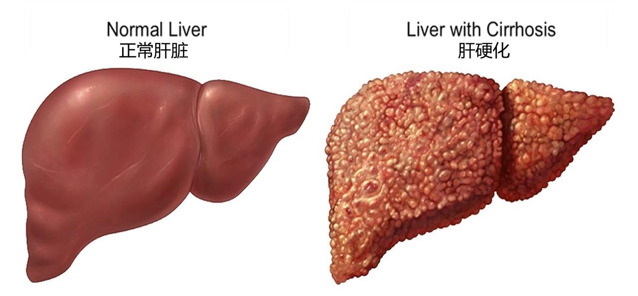 肝硬化不但能控，而且还很好控，控制的又快又好。

“医生，我这肝硬化是不是没救了