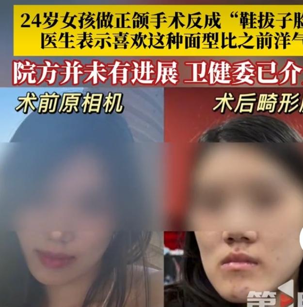 现在正颌手术很火，不少年轻人想借此调整脸型。可武汉24岁的模特小雨，却遭遇了噩梦