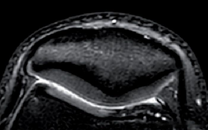 髌骨软化症 【髌骨软化康复】很多朋友膝盖疼痛，拍完核磁片子，然后对一些“专业术语