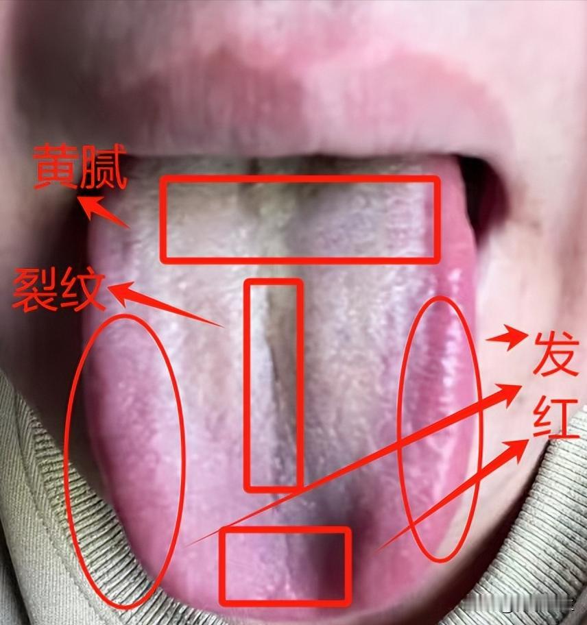 又碰到一个心火旺盛的舌象，用很多的泄火药结果没什么效果，其实原因在这。

患者主