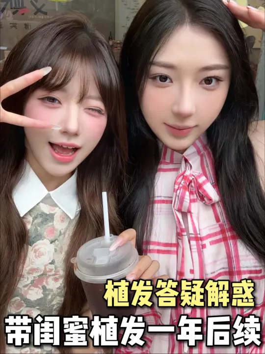 闺蜜植发一年后，头发存活率如何