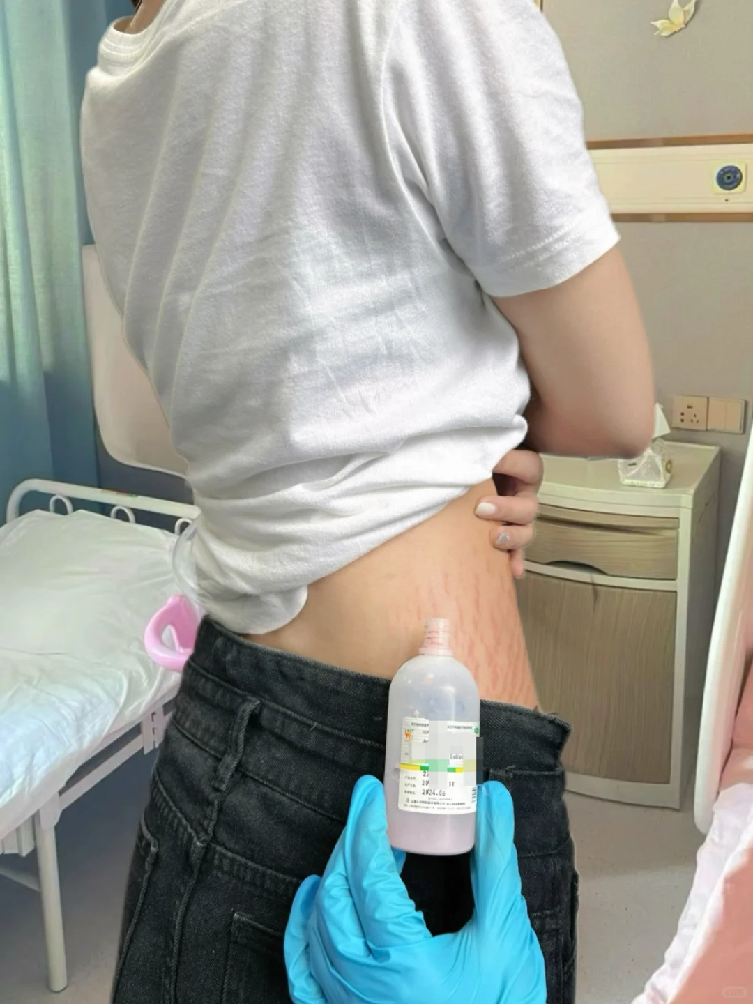重度妊娠纹第一次知道炉甘石的厉害！