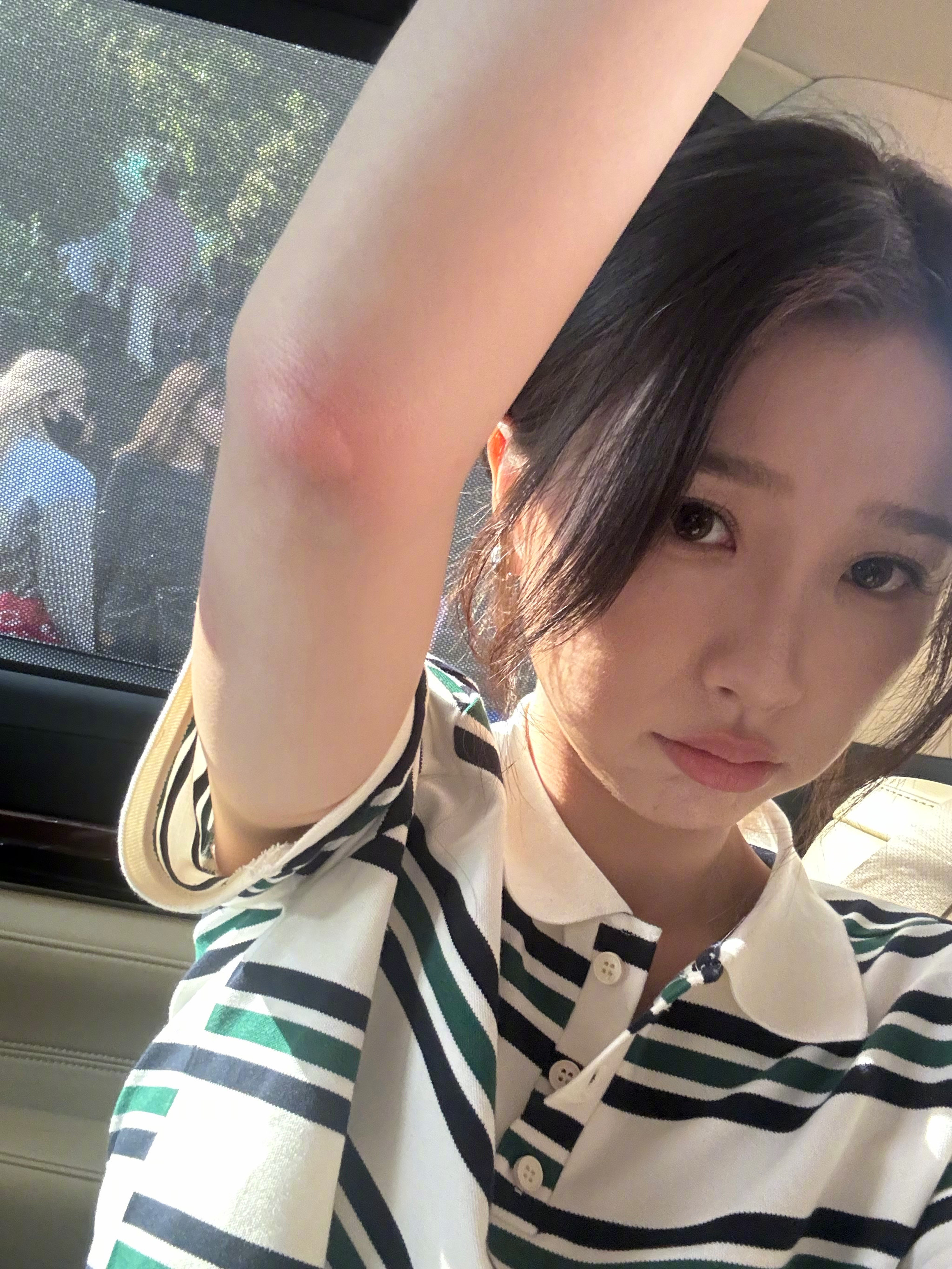 这蚊子吸血鬼啊 咬这么大块 