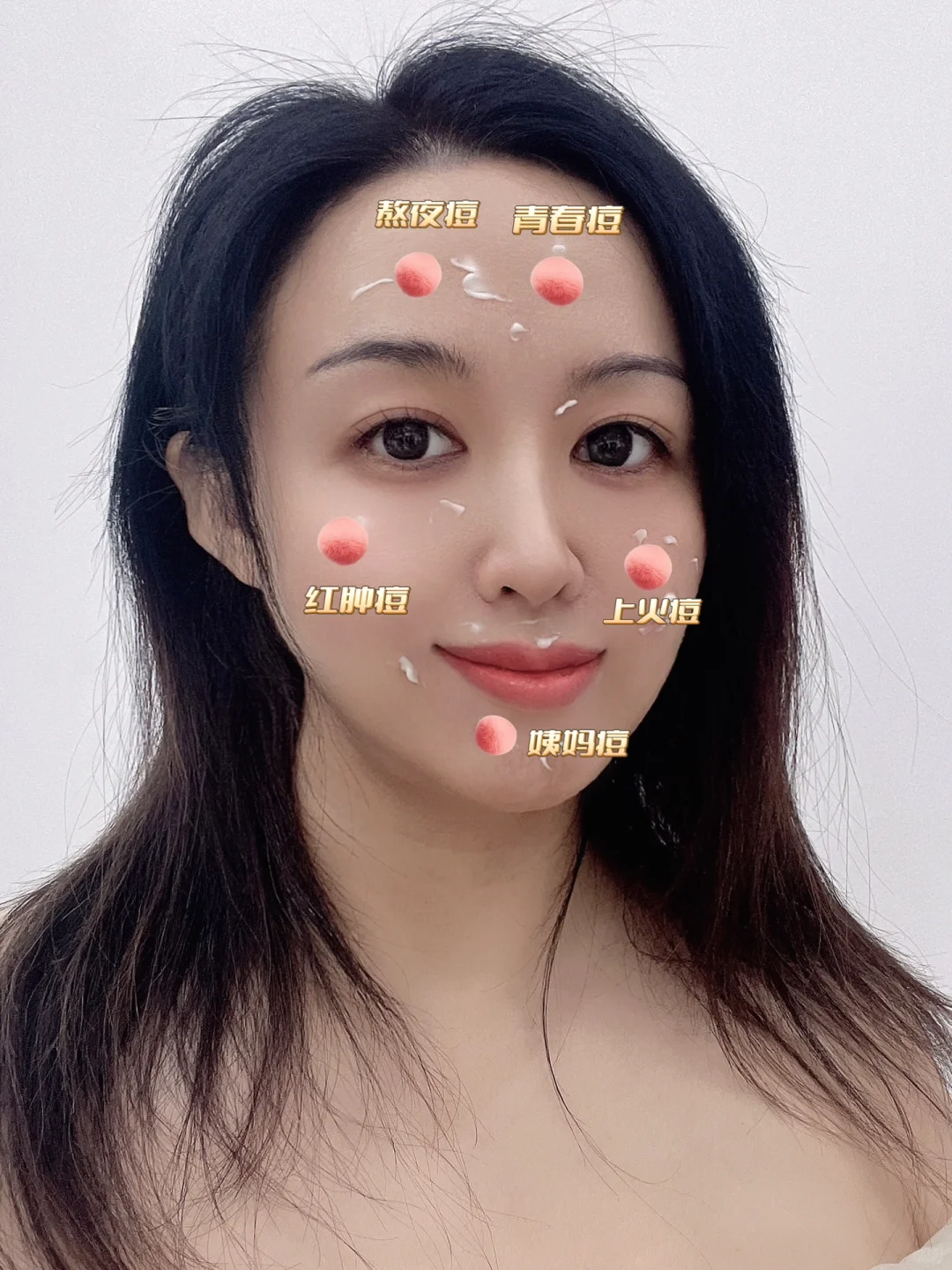 终于战“痘”成功！海洋至尊祛痘膏救大命🆘