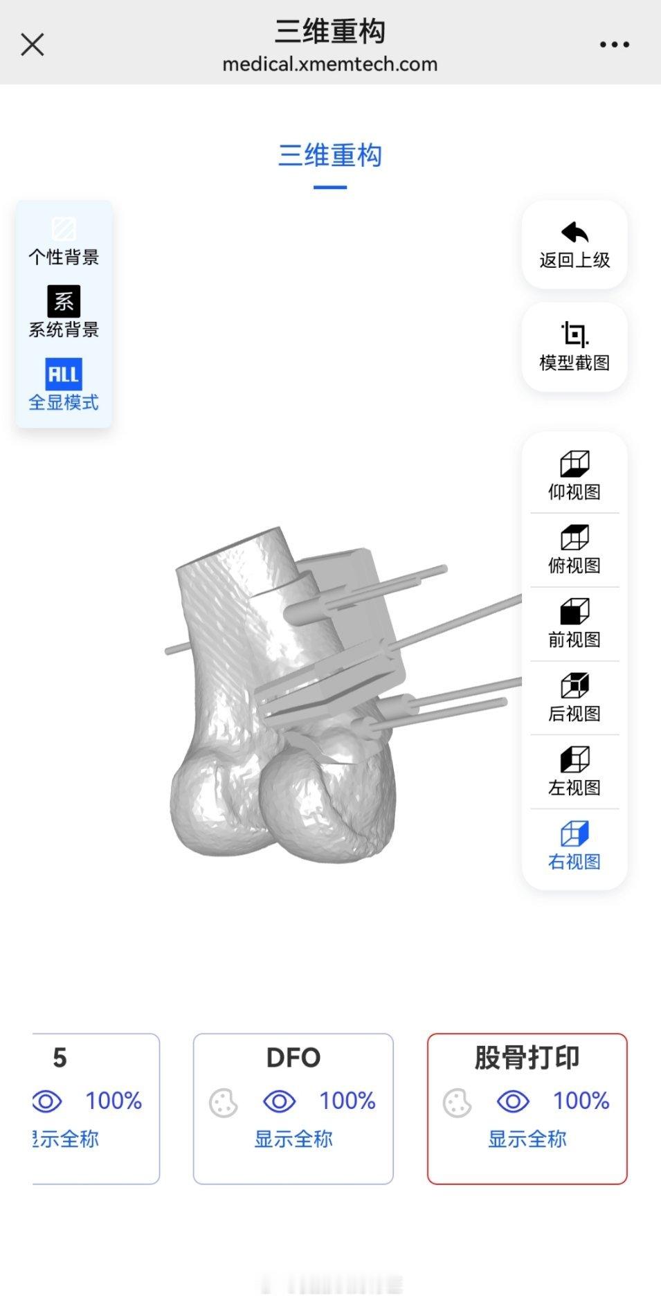 只有术前详细规划，3D打印导板辅助术中精准截骨矫形，术后才能有完美的下肢力线… 