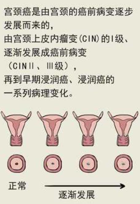 宫颈癌从不足2cm拖到5cm 侥幸一时换来一生悔恨
“医生，我后悔了。当初要是听