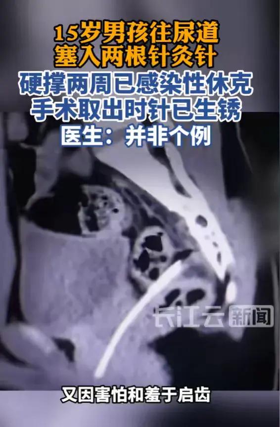 “适龄性教育真的得跟上！”7月1日报道，江苏，一位15岁的男生出于好奇，把两根1
