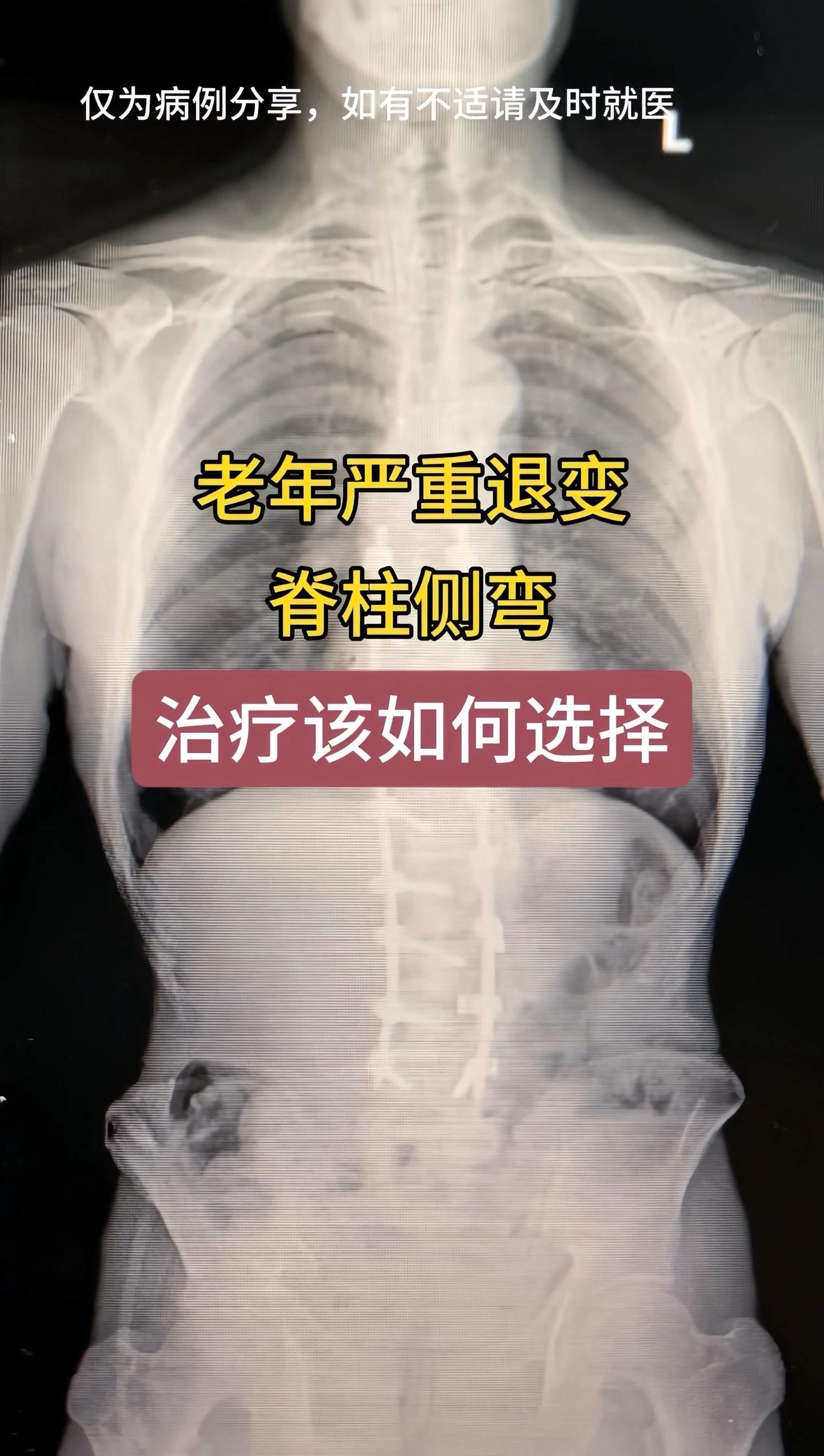 60多岁男性，严重退变侧弯，行走50米左右腰疼及双下肢疼痛麻木严重。生...
