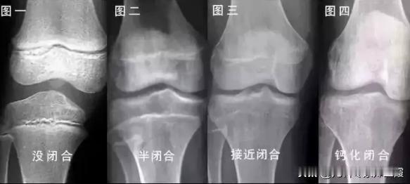骨龄大1岁，少长7公分，导致骨龄偏大的五种常见的原因，家里有孩子的一定要注意了！