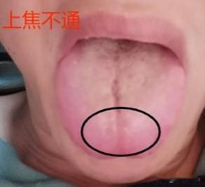 上焦堵多失眠，中焦堵多胃炎，下焦堵老得快，一招打通三焦
上焦堵多失眠
上焦主要包