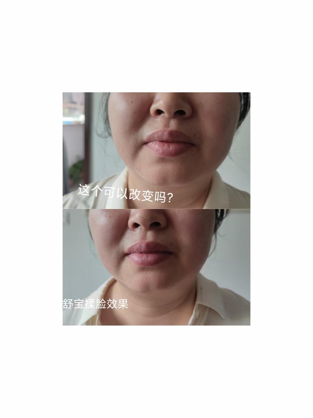  面部刮痧搭配涂儒舒宝[爱心][爱心]肤色亮了，面部柔和了，色斑淡了，法令纹淡了