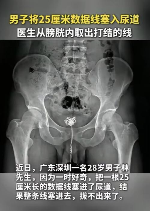 离谱！28岁成年人一时好奇，把25cm数据线塞进尿道，最后在膀胱里打了死结。
 
