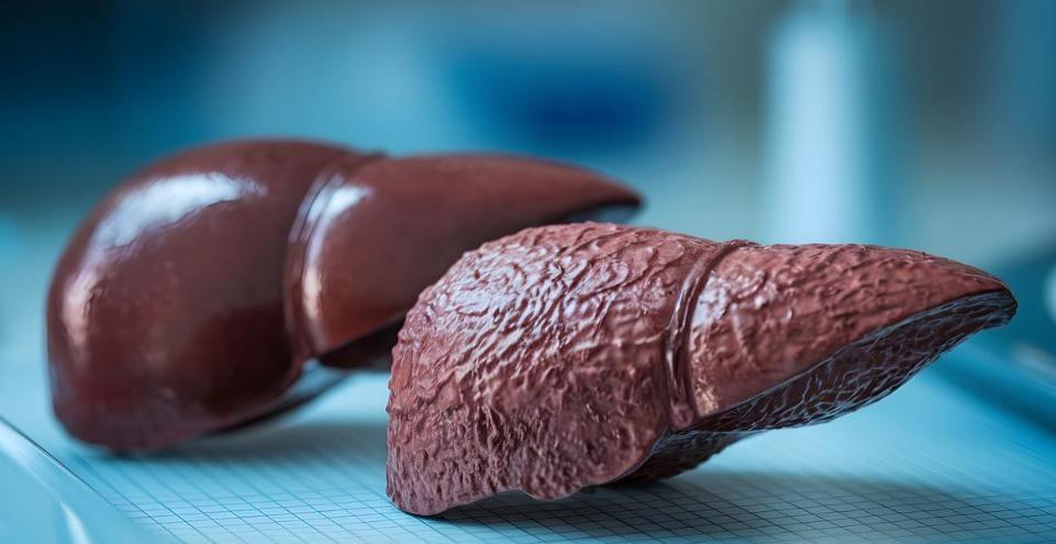 人不会无缘无故患肝硬化！研究发现：得肝硬化的人，离不开这5点

肝硬化诊断出来的