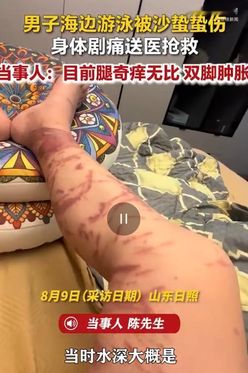 山东日照，男子下海游泳，万万没想到在浅水区突然遭遇了水下“隐形杀手”，当场像触了