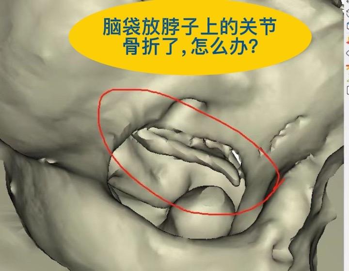 枕骨髁骨折，脑袋放脖子上的关节骨折。枕骨髁骨折Tuli分型IIB型，给...