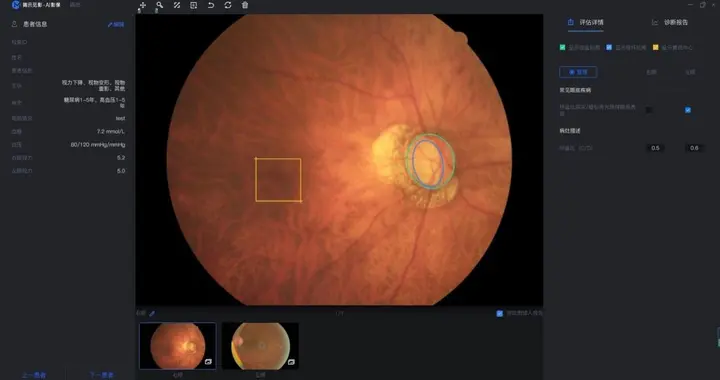 创新医疗|腾讯获批创新医疗器械 AI辅助有望解决青光眼诊断难题