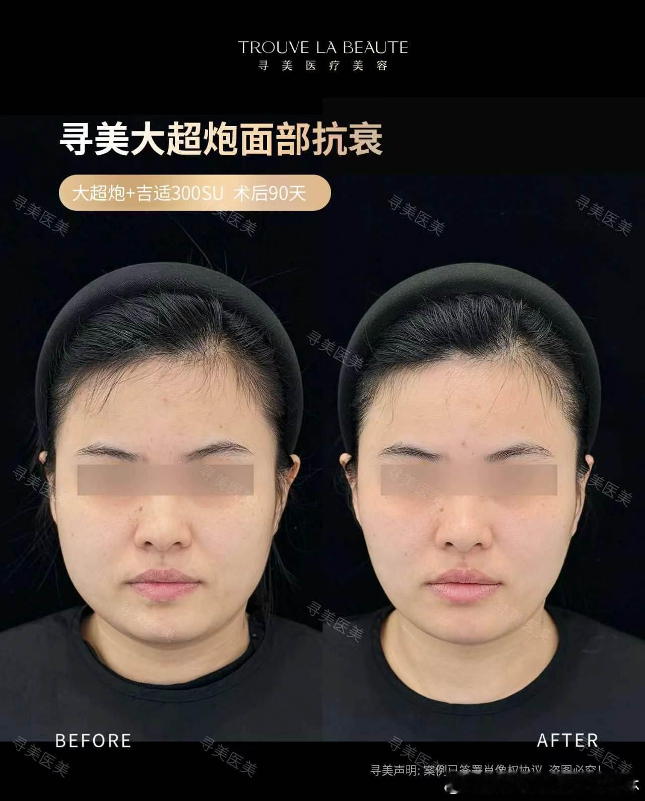 这个就是我之前说的通过光电和部分针剂把脸打的又小又紧至于为什么选的是三个月因为要