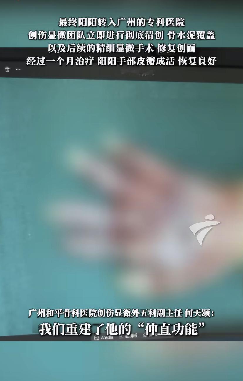 3岁娃手伸进奶茶封口机，一个月里骨头都坏死了!医生这句话，家长千万记住
江门一个