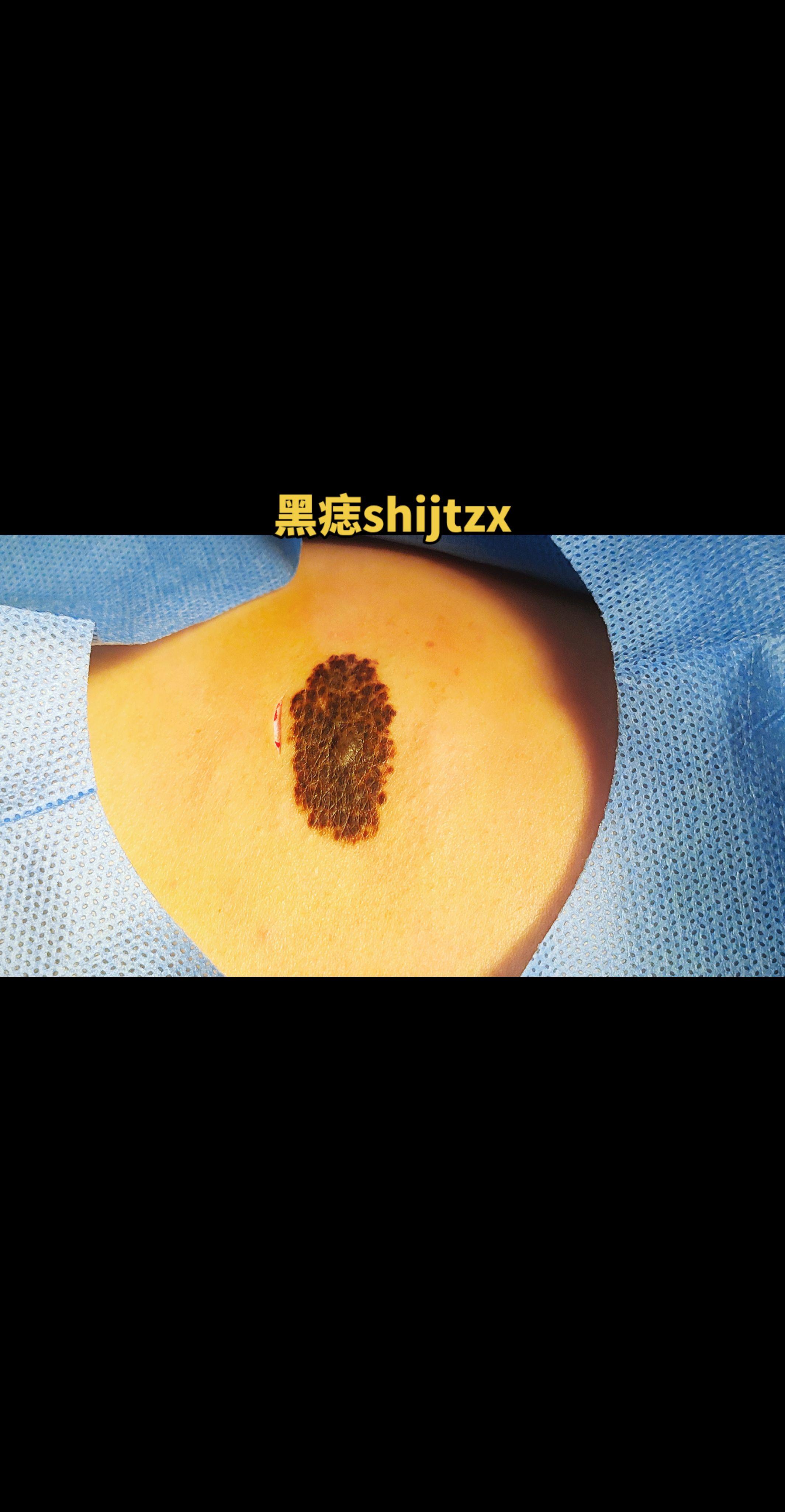 黑痣。黑痣切除分层减张免拆线整形缝合。