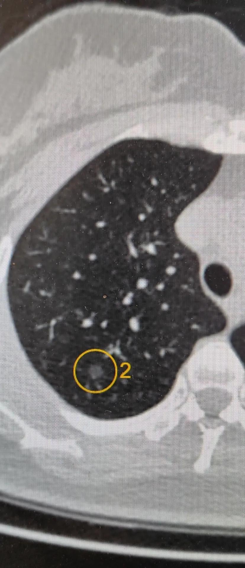 5毫米以下的结节为什么不着急做手术？这是他的性质决定的
肺部结节是不是查出来就要