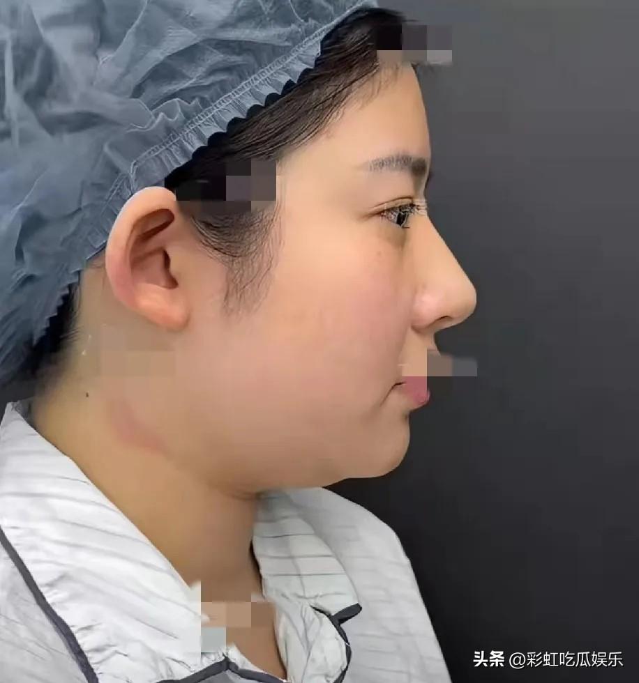 黄一鸣整容前后对比图，主要是开眼角割双眼皮垫鼻子花了10w，整容前是妇女整容后变