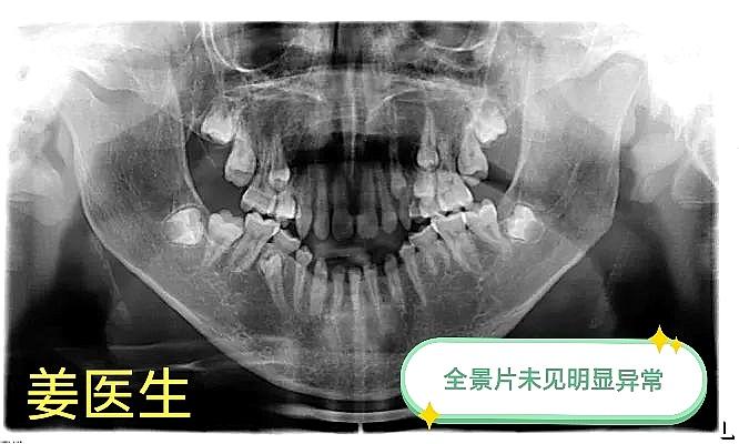 颌骨血管瘤：牙医拔牙触雷！任何看似简单的手术都可能出乎意料地出错。拔了...