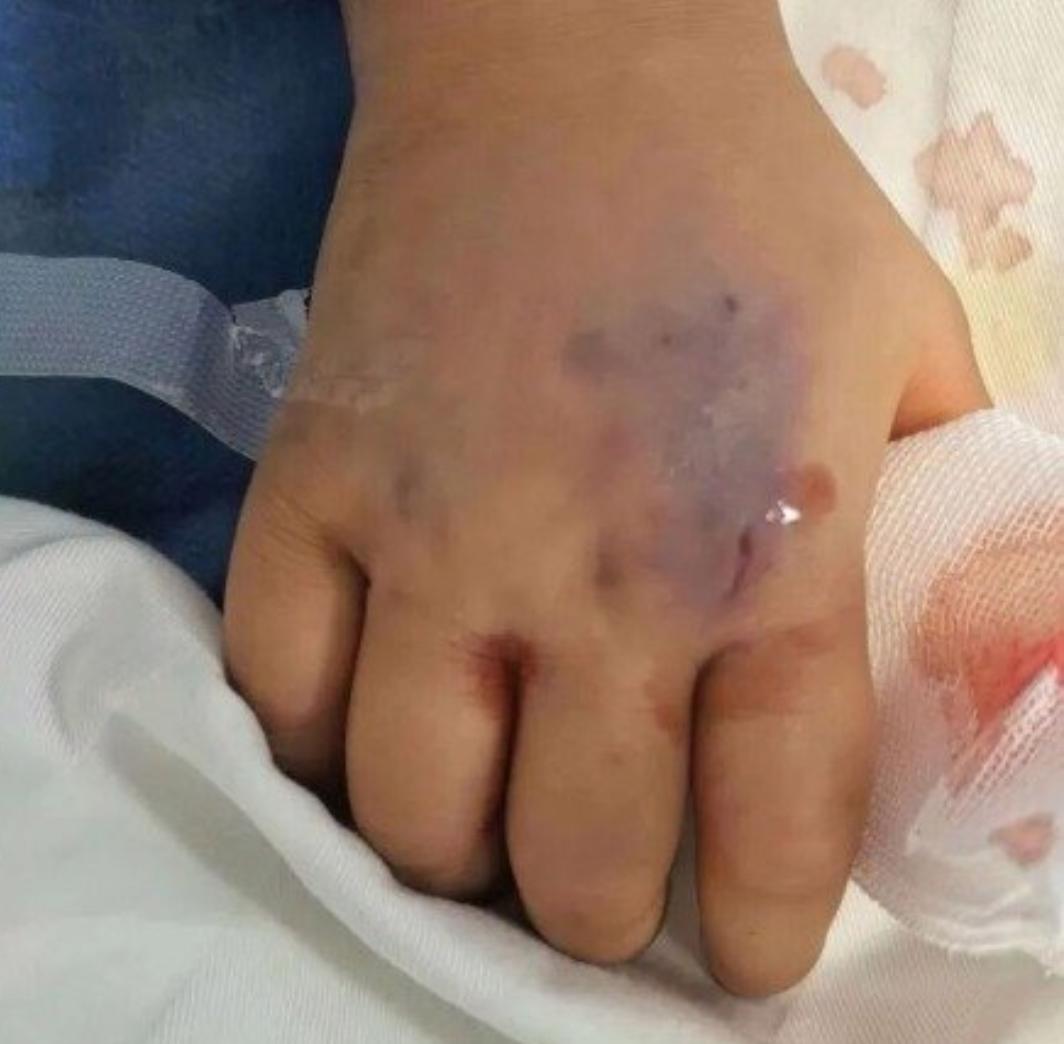 3岁女童被毒蛇咬伤假死3天，一针血清唤醒生命，看完泪目！
 
你敢信吗？一个才3