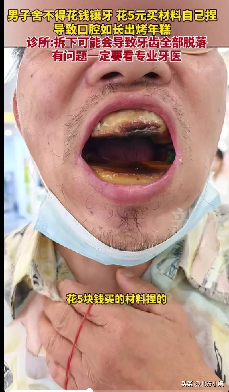 一位男子因舍不得花钱去镶牙，就自行在网上购买了5元材料，自行去镶牙，然而并没有成