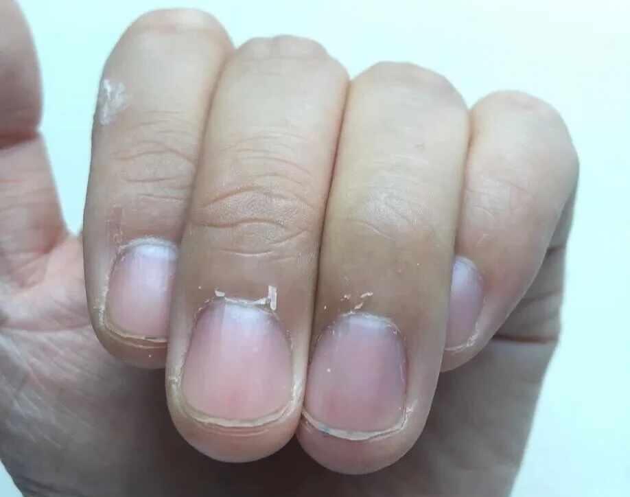 手上的捯刺可以拔吗
还有问问我手上老是比较干燥的是不是缺什么维生素呀？不懂就问 