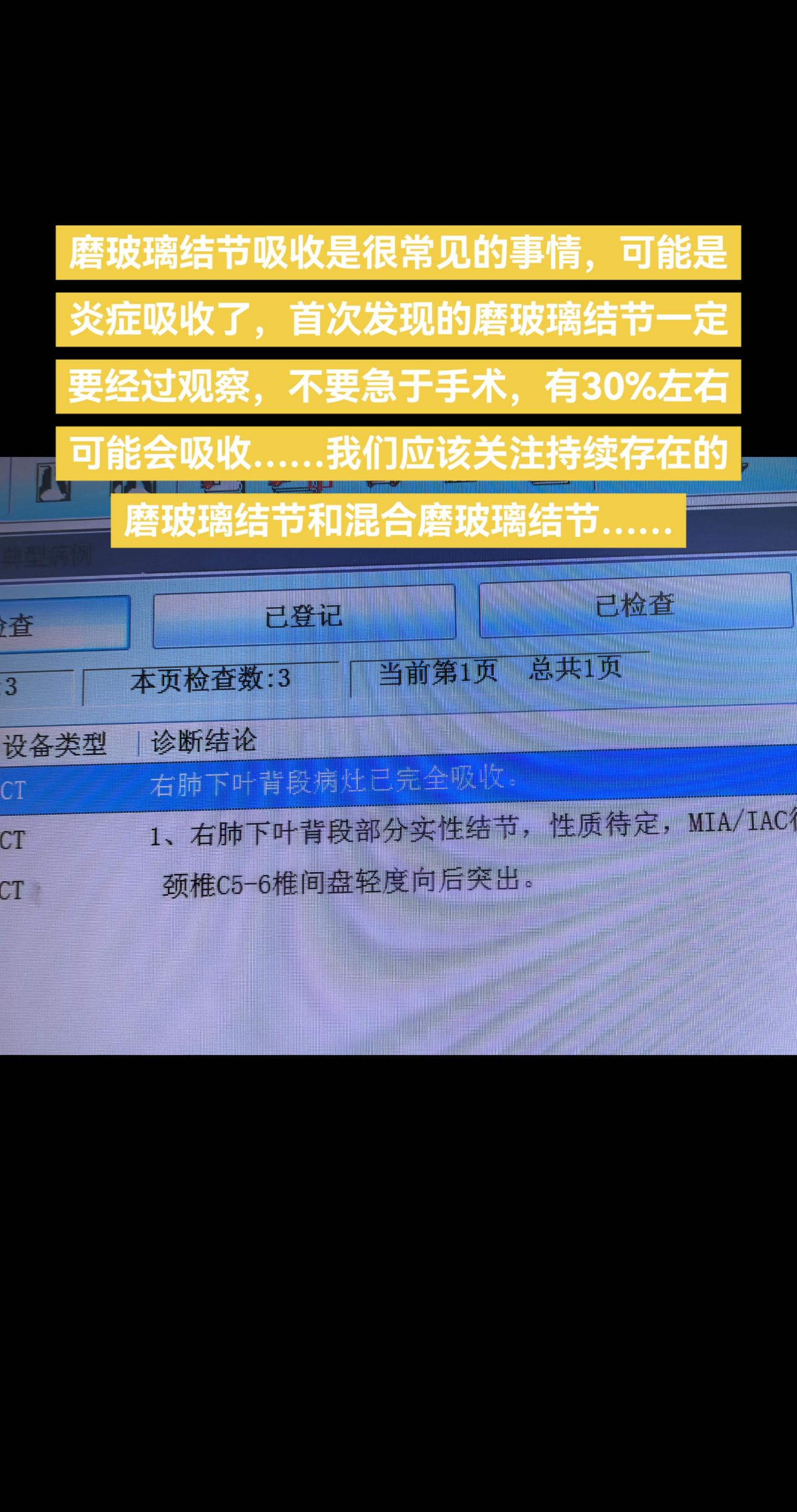 首次发现的磨玻璃结节一定要经过观察。磨玻璃结节吸收是很常见的事情，可能...
