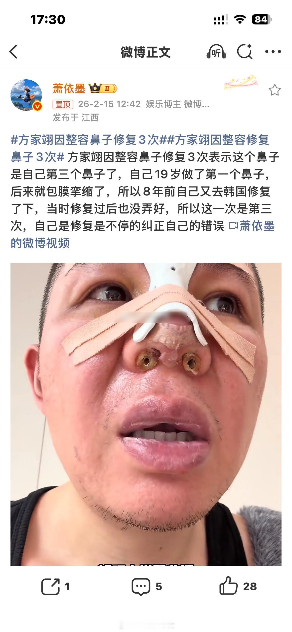 方家翊因整容鼻子修复3次这鼻子居然整了三次？真的排毒他的勇气啊，我反正是不敢 