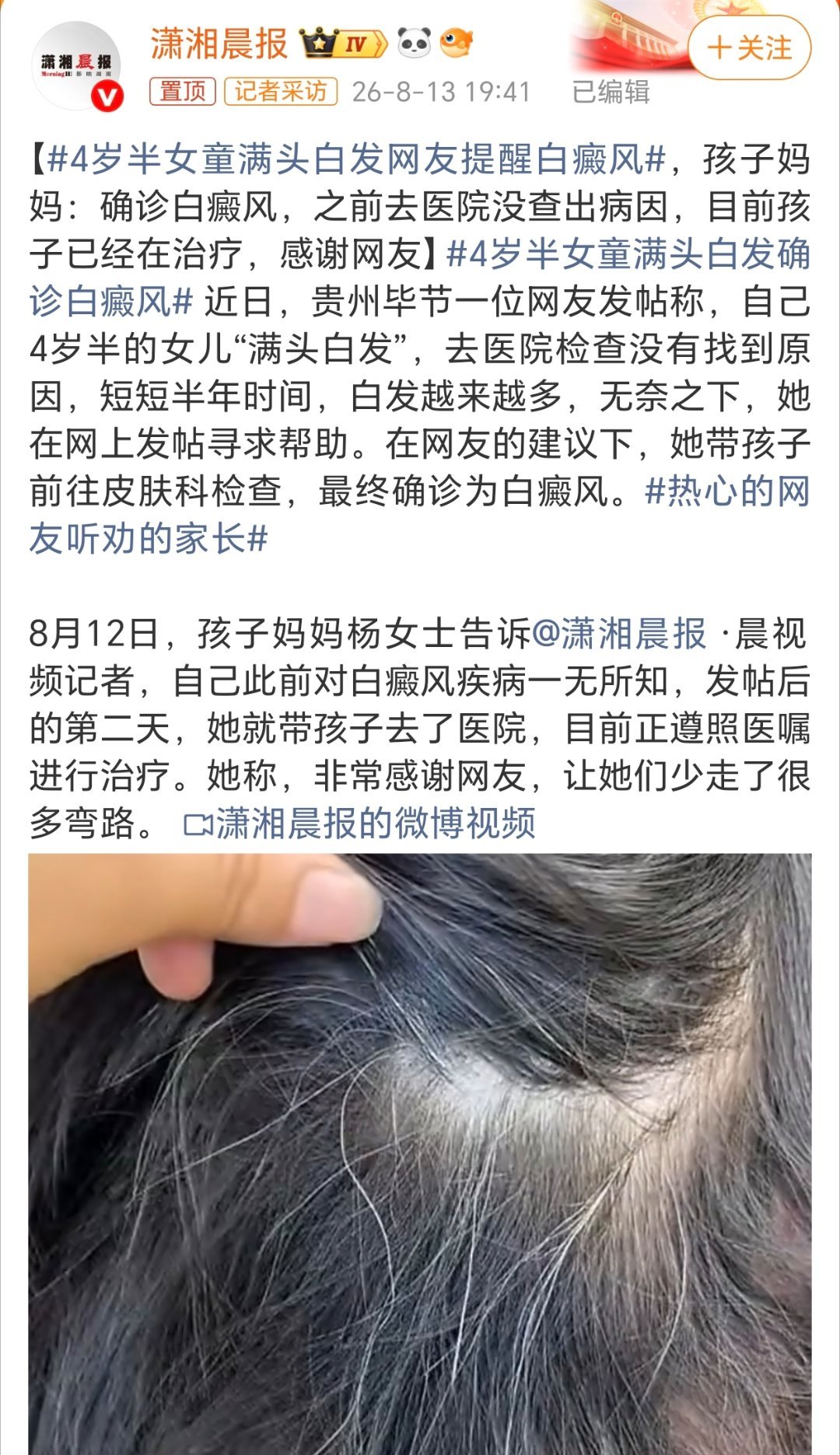 4岁半女童满头白发网友提醒白癜风网友太给力了！确实有时候自己身体状况有问题不确定