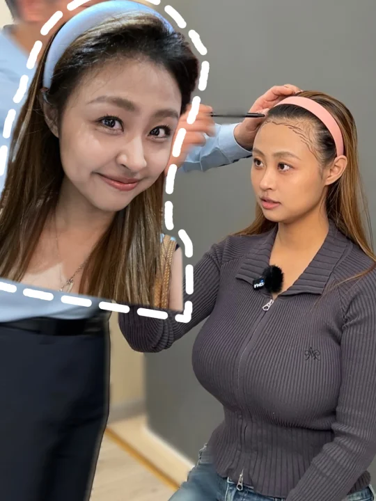 终于植发快一年！效果反馈🙋🏼‍♀️有问必答贴