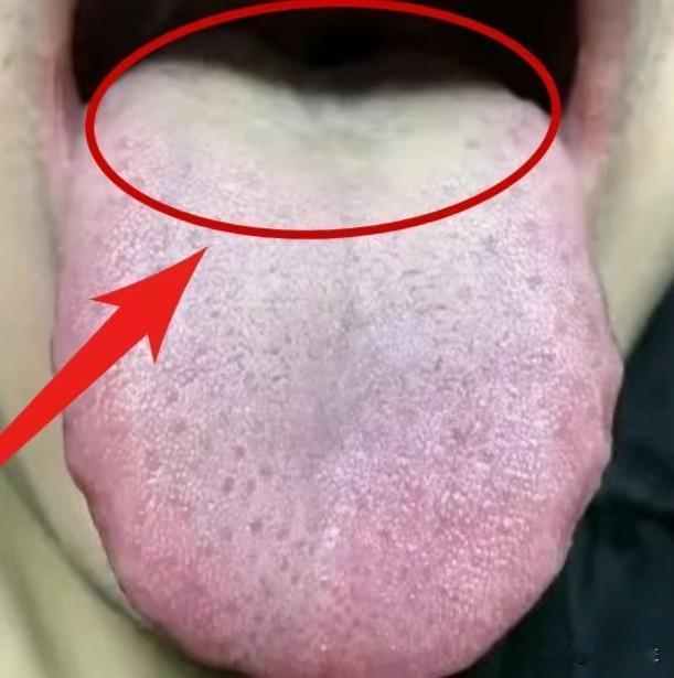 这种舌象，同时存在阴虚、湿热和气虚的问题，其实调理起来并非难事！

患者自述：感
