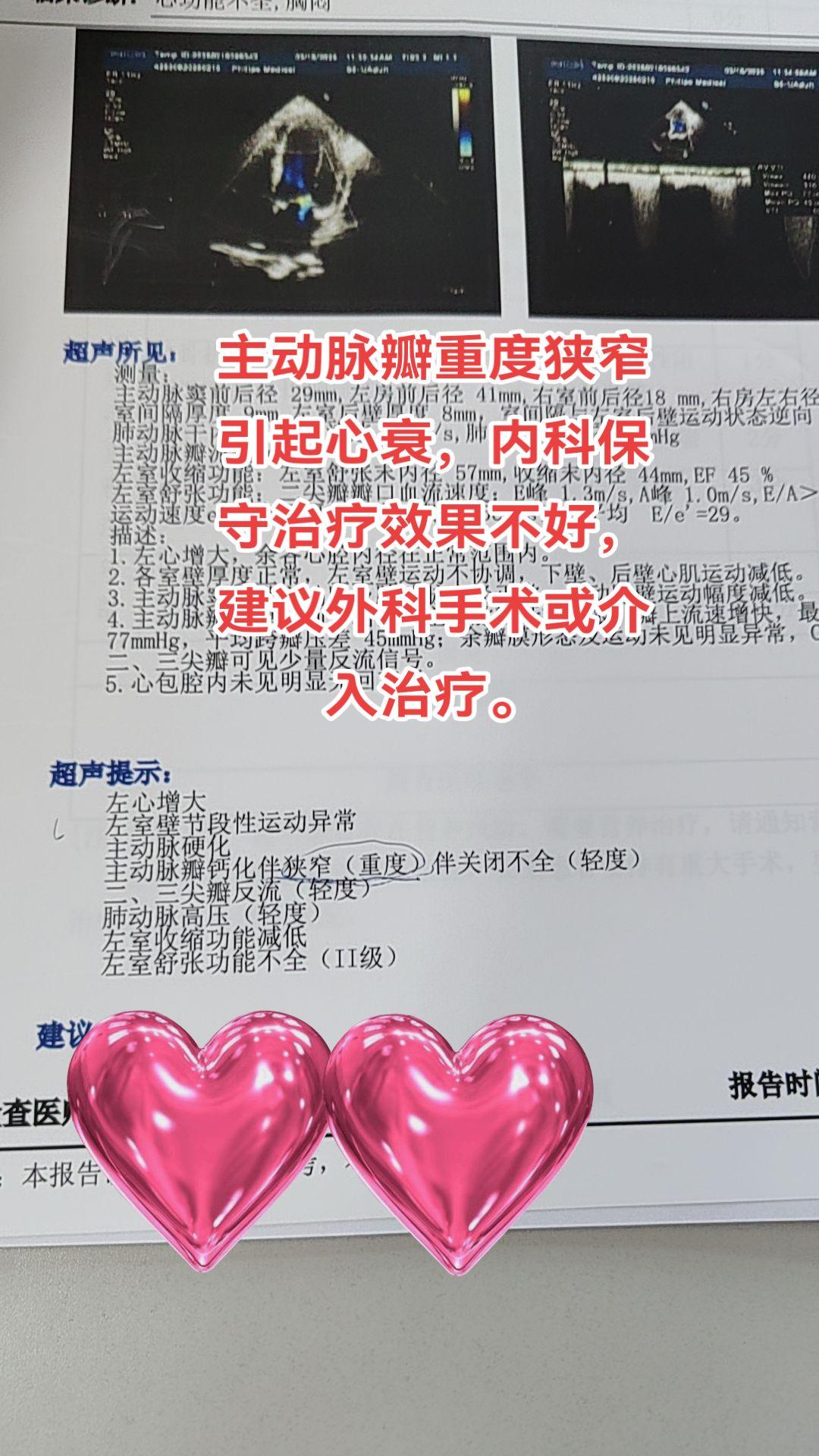 主动脉瓣狭窄。