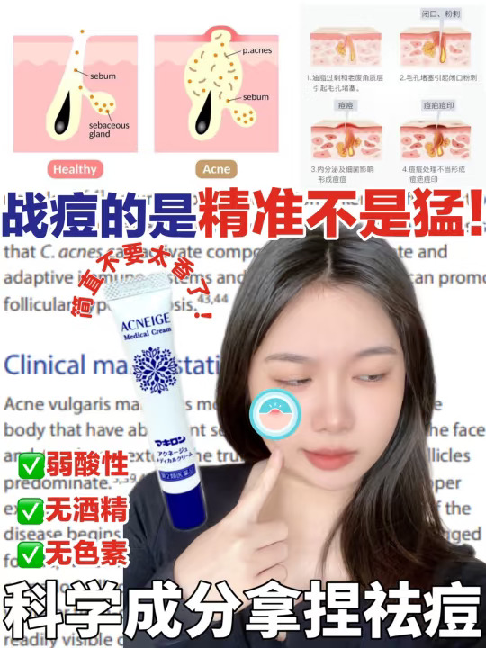 战痘的路上怎么能少了它