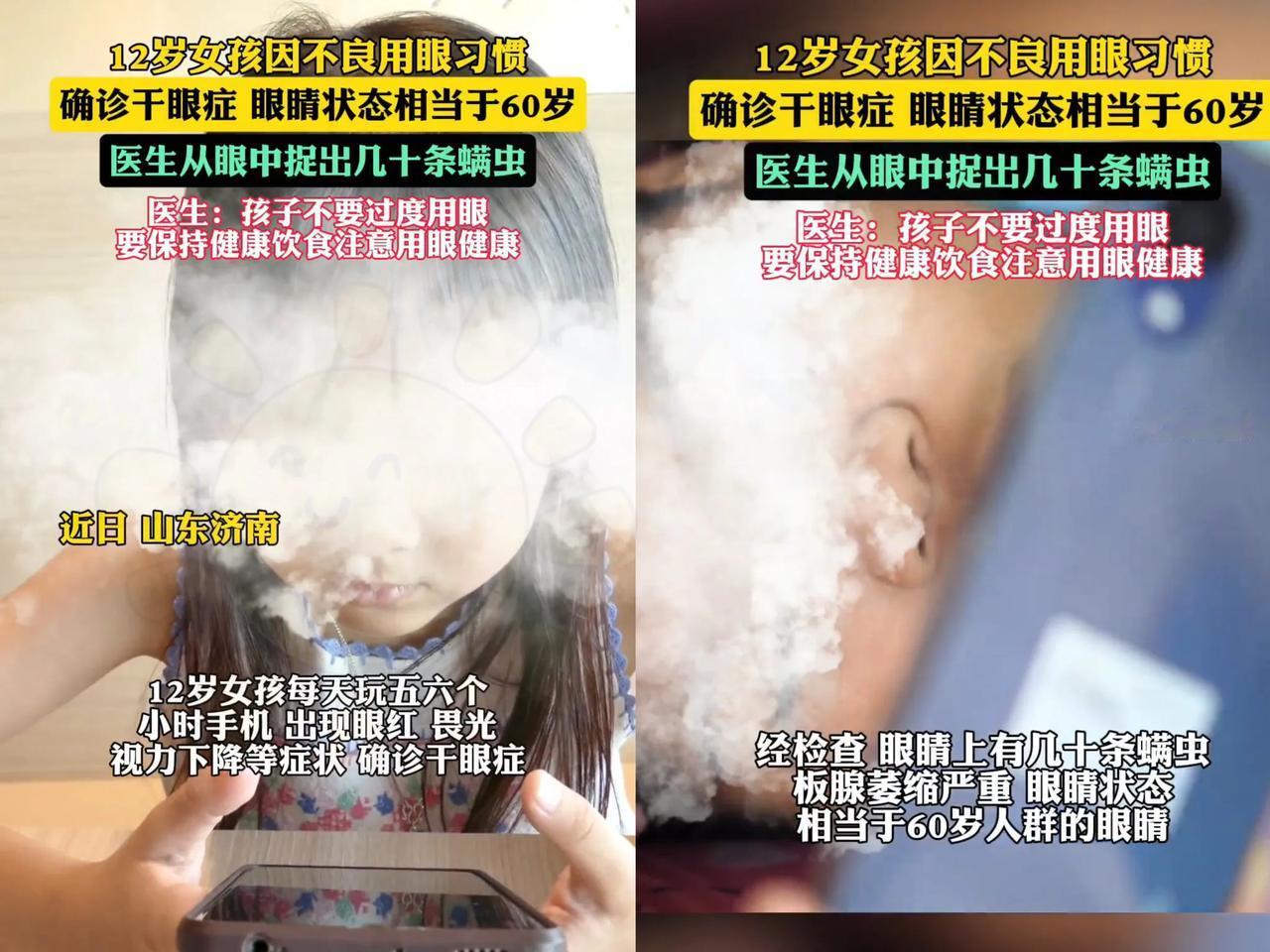 太可怕了！山东济南，12岁女孩因沉迷电子产品，竟然患上了严重的干眼症！每天五六个