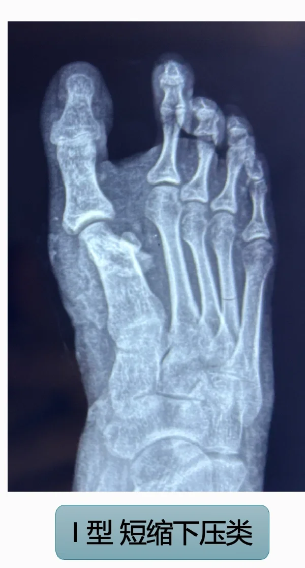 微创术后畸形～～一种新型畸形